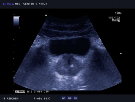 Ultrazvok prostate - benigna hipertrofija prostate 11